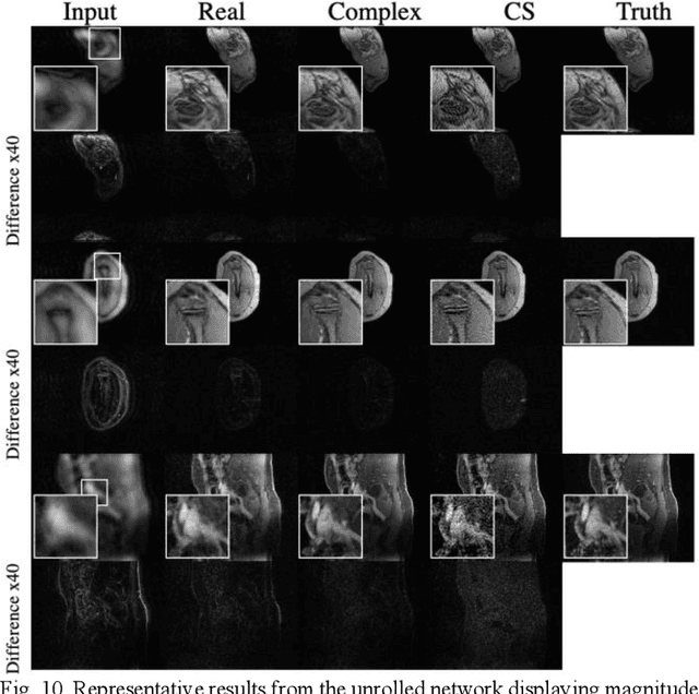 Figure 2 for Complex-Valued Convolutional Neural Networks for MRI Reconstruction