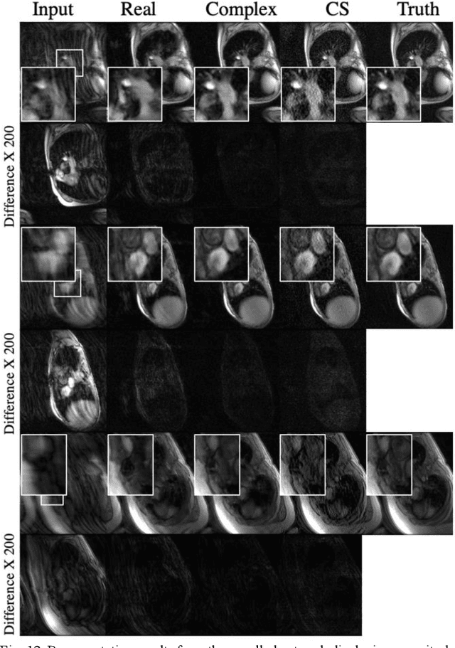 Figure 4 for Complex-Valued Convolutional Neural Networks for MRI Reconstruction