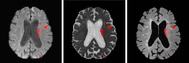 Figure 1 for Automated ischemic stroke lesion segmentation from 3D MRI