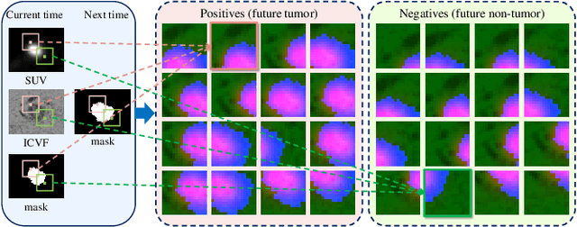 Figure 4 for Convolutional Invasion and Expansion Networks for Tumor Growth Prediction