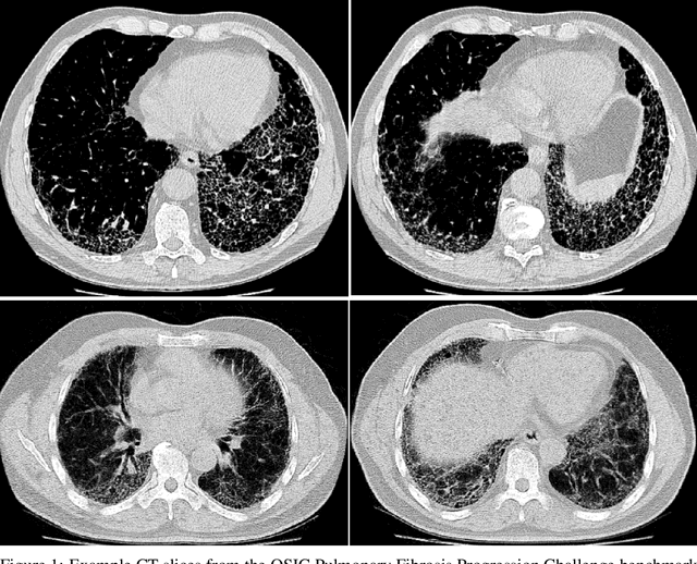 Figure 1 for Fibrosis-Net: A Tailored Deep Convolutional Neural Network Design for Prediction of Pulmonary Fibrosis Progression from Chest CT Images