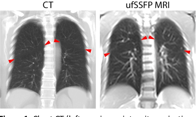 Figure 2 for MRI lung lobe segmentation in pediatric cystic fibrosis patients using a recurrent neural network trained with publicly accessible CT datasets