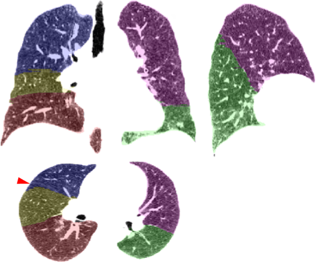 Figure 4 for MRI lung lobe segmentation in pediatric cystic fibrosis patients using a recurrent neural network trained with publicly accessible CT datasets