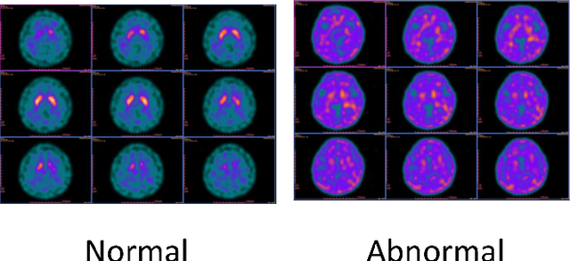 Figure 1 for Dopamine Transporter SPECT Image Classification for Neurodegenerative Parkinsonism via Diffusion Maps and Machine Learning Classifiers