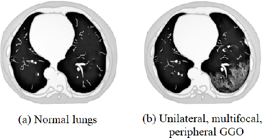 Figure 3 for CHS-Net: A Deep learning approach for hierarchical segmentation of COVID-19 infected CT images