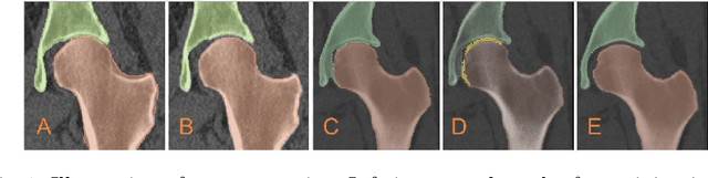 Figure 1 for Auto-segmentation of Hip Joints using MultiPlanar UNet with Transfer learning