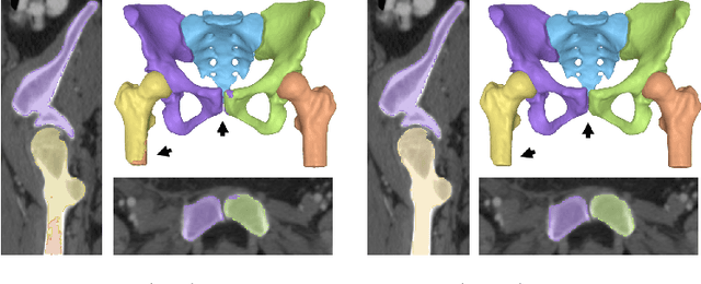 Figure 3 for Auto-segmentation of Hip Joints using MultiPlanar UNet with Transfer learning