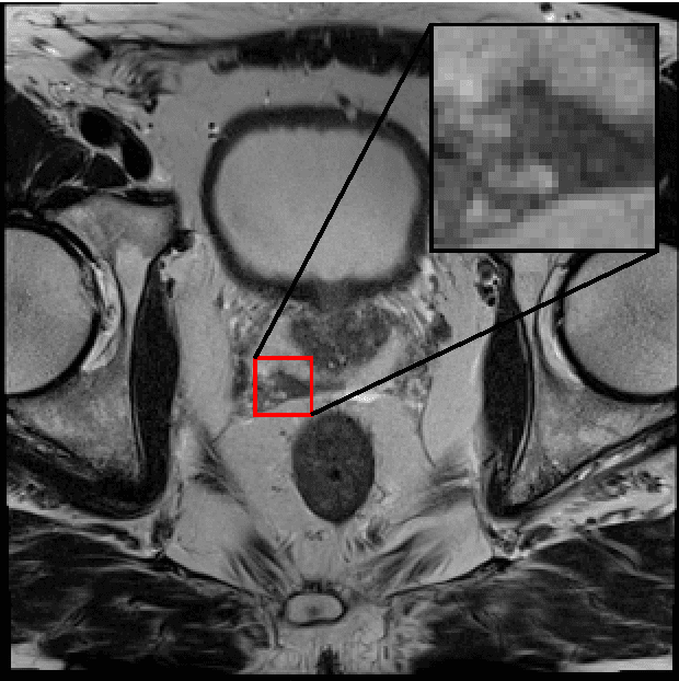 Figure 1 for Deep Generative Adversarial Neural Networks for Realistic Prostate Lesion MRI Synthesis