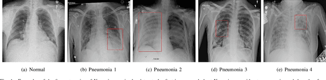 Figure 1 for Deep Pneumonia: Attention-Based Contrastive Learning for Class-Imbalanced Pneumonia Lesion Recognition in Chest X-rays