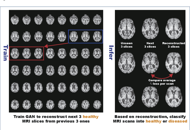 Figure 1 for MADGAN: unsupervised Medical Anomaly Detection GAN using multiple adjacent brain MRI slice reconstruction
