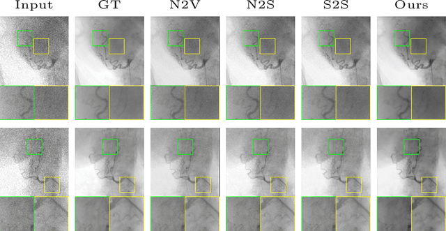 Figure 4 for Stabilize, Decompose, and Denoise: Self-Supervised Fluoroscopy Denoising