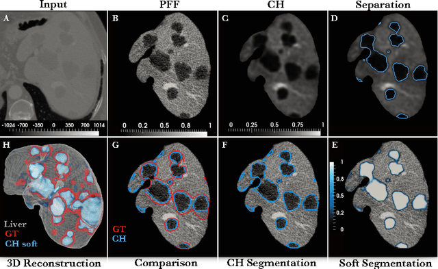 Figure 1 for Automated Unsupervised Segmentation of Liver Lesions in CT scans via Cahn-Hilliard Phase Separation