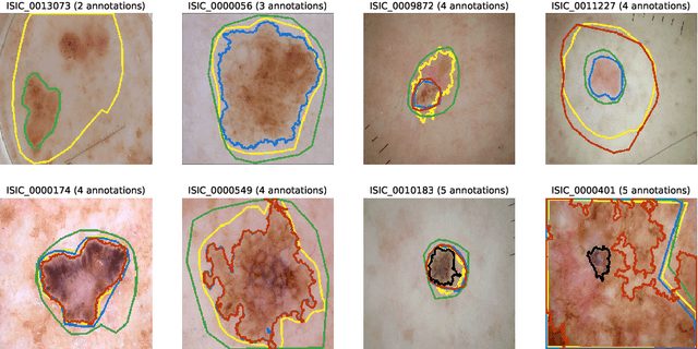 Figure 1 for D-LEMA: Deep Learning Ensembles from Multiple Annotations -- Application to Skin Lesion Segmentation