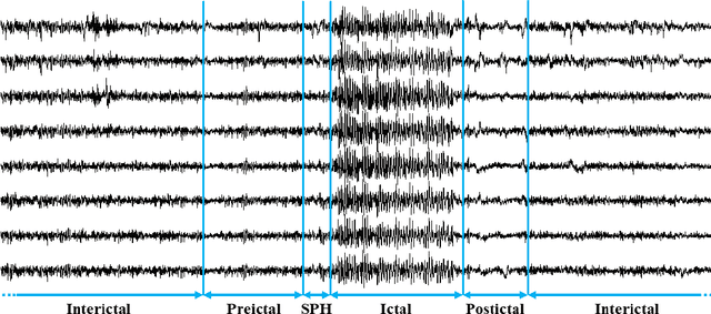 Figure 1 for EEG-Based Epileptic Seizure Prediction Using Temporal Multi-Channel Transformers