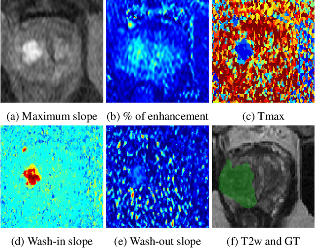 Figure 1 for Perfusion imaging in deep prostate cancer detection from mp-MRI: can we take advantage of it?