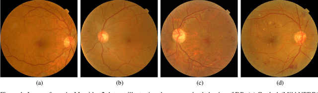 Figure 1 for Cost-Sensitive Regularization for Diabetic Retinopathy Grading from Eye Fundus Images