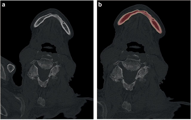 Figure 2 for Computed tomography data collection of the complete human mandible and valid clinical ground truth models