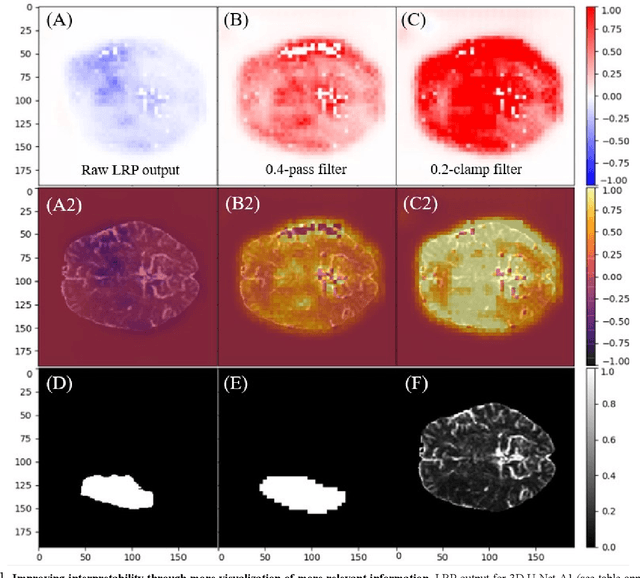 Figure 1 for Enhancing the Extraction of Interpretable Information for Ischemic Stroke Imaging from Deep Neural Networks