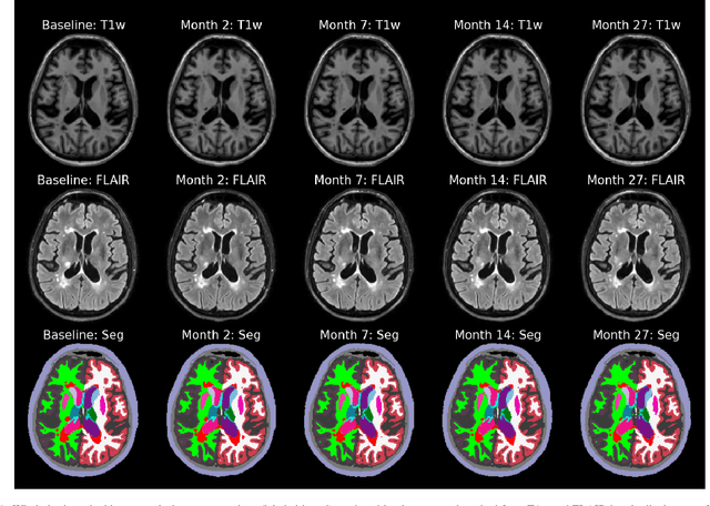 Figure 1 for An Open-Source Tool for Longitudinal Whole-Brain and White Matter Lesion Segmentation