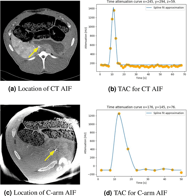 Figure 1 for Application of Time Separation Technique to Enhance C-arm CT Dynamic Liver Perfusion Imaging