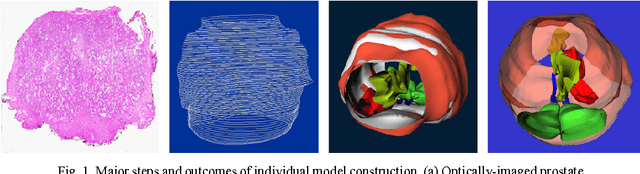 Figure 1 for A feasible roadmap for developing volumetric probability atlas of localized prostate cancer