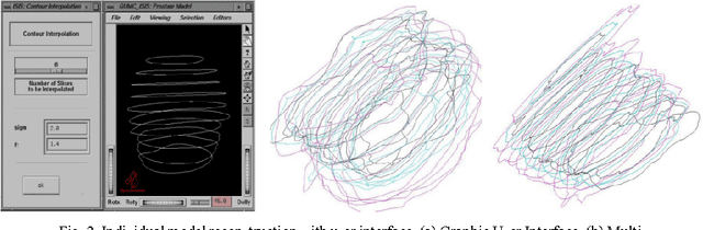 Figure 2 for A feasible roadmap for developing volumetric probability atlas of localized prostate cancer