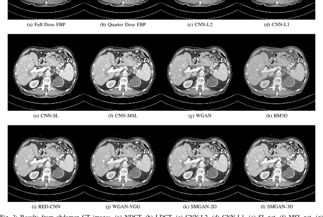 Figure 4 for Structure-sensitive Multi-scale Deep Neural Network for Low-Dose CT Denoising