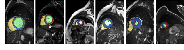 Figure 3 for Automatic Segmentation and Disease Classification Using Cardiac Cine MR Images