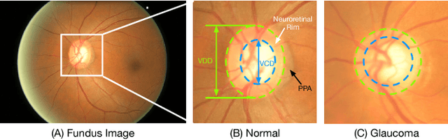 Figure 1 for Joint Optic Disc and Cup Segmentation Based on Multi-label Deep Network and Polar Transformation