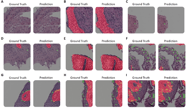 Figure 3 for Harnessing Artificial Intelligence to Infer Novel Spatial Biomarkers for the Diagnosis of Eosinophilic Esophagitis