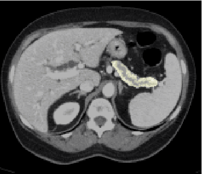 Figure 1 for Efficient, high-performance pancreatic segmentation using multi-scale feature extraction
