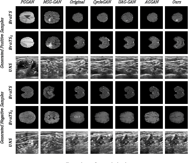 Figure 3 for SAG-GAN: Semi-Supervised Attention-Guided GANs for Data Augmentation on Medical Images