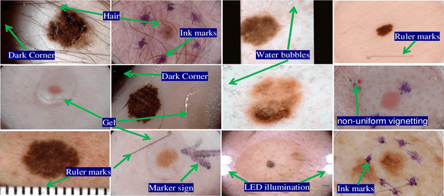 Figure 1 for DSNet: Automatic Dermoscopic Skin Lesion Segmentation