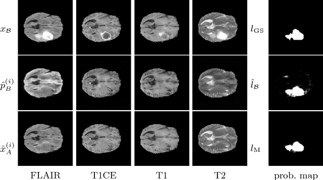 Figure 2 for Pathology Segmentation using Distributional Differences to Images of Healthy Origin