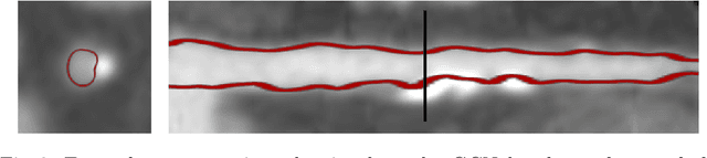 Figure 4 for Graph Convolutional Networks for Coronary Artery Segmentation in Cardiac CT Angiography