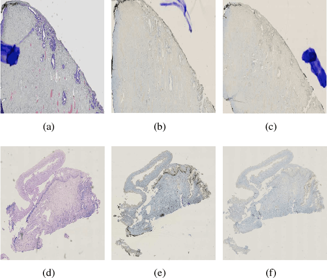 Figure 3 for A Whole Slide Image Grading Benchmark and Tissue Classification for Cervical Cancer Precursor Lesions with Inter-Observer Variability