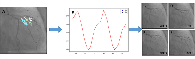 Figure 4 for Automatic Identification of the End-Diastolic and End-Systolic Cardiac Frames from Invasive Coronary Angiography Videos