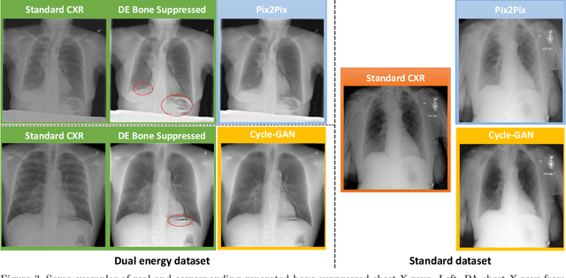 Figure 4 for Bone Suppression on Chest Radiographs With Adversarial Learning