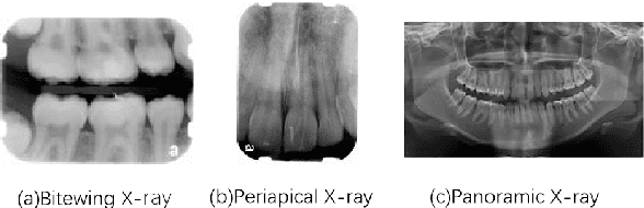 Figure 1 for An Adaptive Enhancement Based Hybrid CNN Model for Digital Dental X-ray Positions Classification