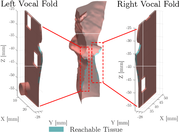 Figure 2 for Light in the Larynx: a Miniaturized Robotic Optical Fiber for In-office Laser Surgery of the Vocal Folds