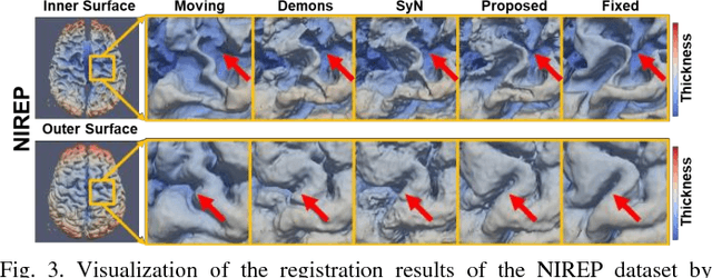 Figure 3 for Deep Morphological Simplification Network (MS-Net) for Guided Registration of Brain Magnetic Resonance Images