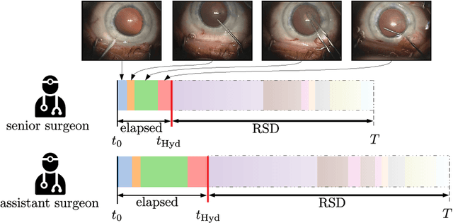 Figure 1 for CataNet: Predicting remaining cataract surgery duration