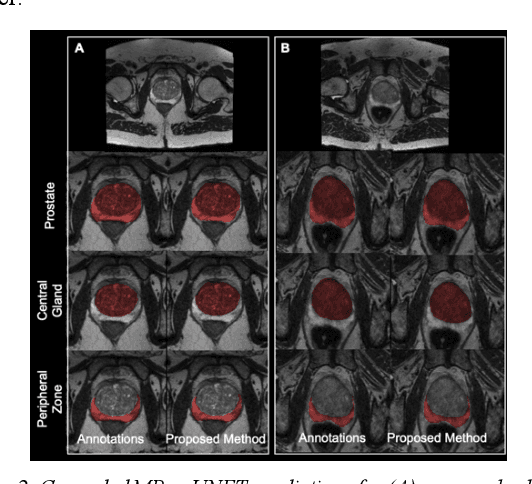 Figure 3 for A Cascaded Residual UNET for Fully Automated Segmentation of Prostate and Peripheral Zone in T2-weighted 3D Fast Spin Echo Images