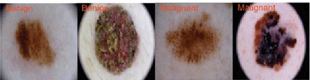 Figure 1 for Robust Learning at Noisy Labeled Medical Images: Applied to Skin Lesion Classification