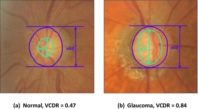 Figure 1 for Segmentation-based Information Extraction and Amalgamation in Fundus Images for Glaucoma Detection