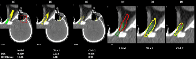 Figure 4 for A Proof-of-Concept Study of Artificial Intelligence Assisted Contour Revision