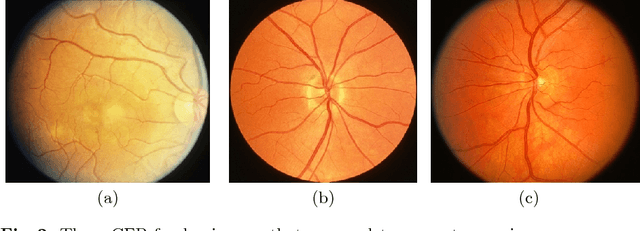 Figure 3 for Synthesizing New Retinal Symptom Images by Multiple Generative Models