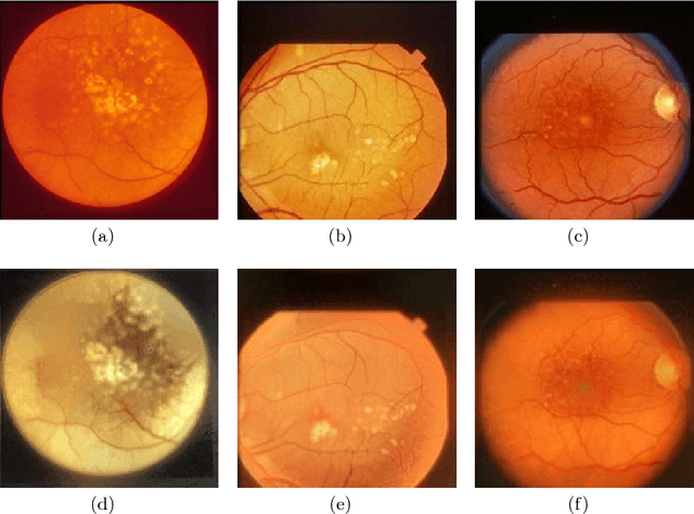 Figure 4 for Synthesizing New Retinal Symptom Images by Multiple Generative Models