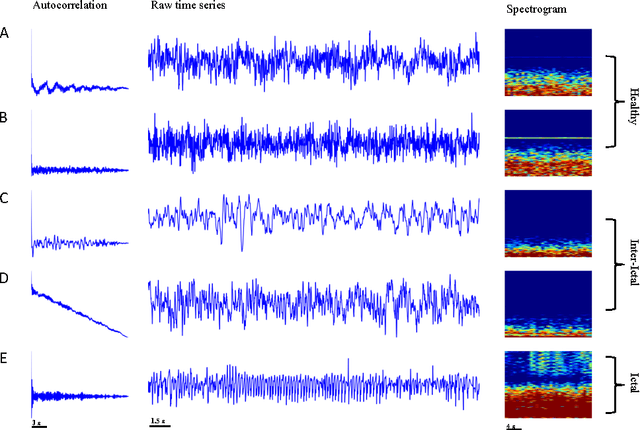 Figure 1 for Deep Recurrent Neural Networks for seizure detection and early seizure detection systems