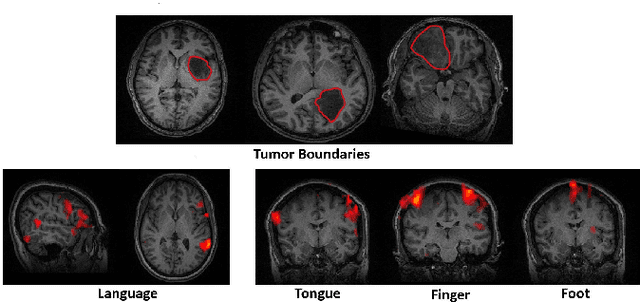 Figure 3 for A Multi-Task Deep Learning Framework to Localize the Eloquent Cortex in Brain Tumor Patients Using Dynamic Functional Connectivity